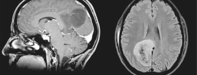 tumor