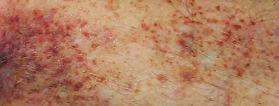 venoese_insuffizienz