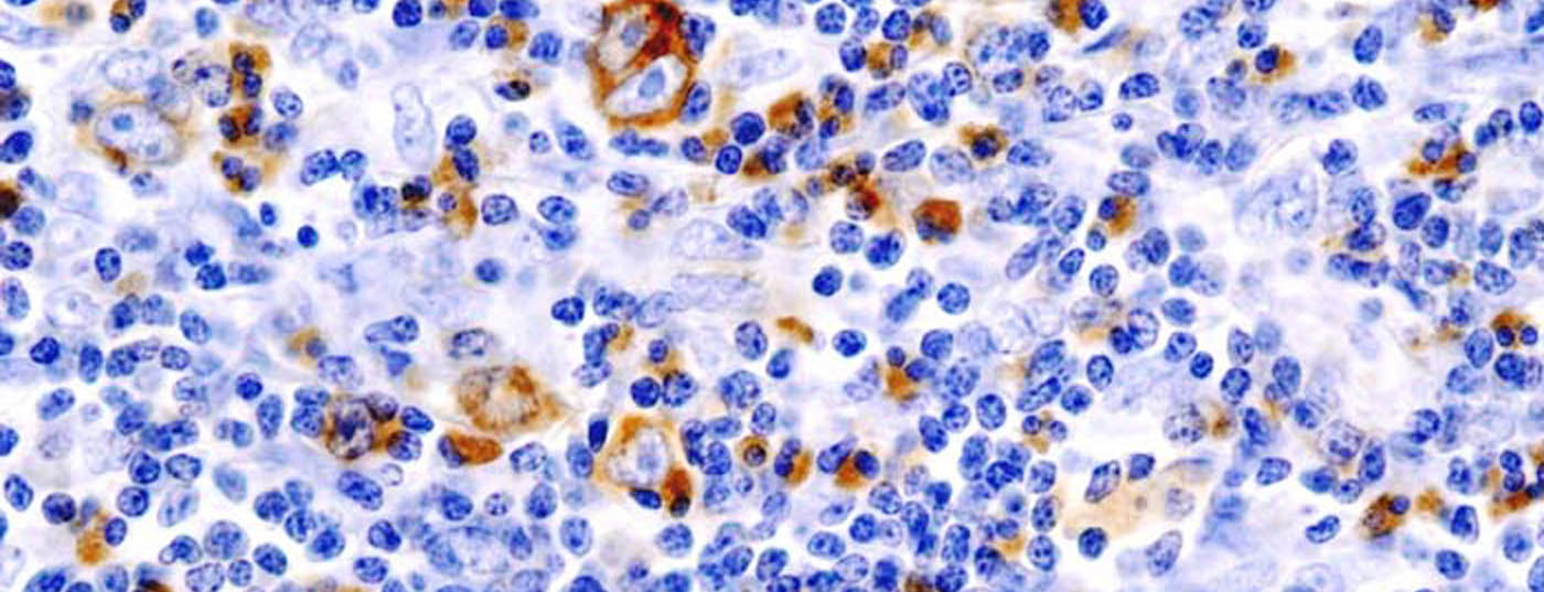 lymphom