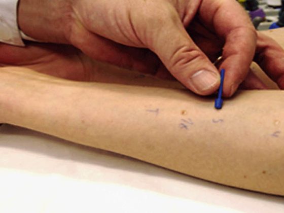 prick_allergie_test