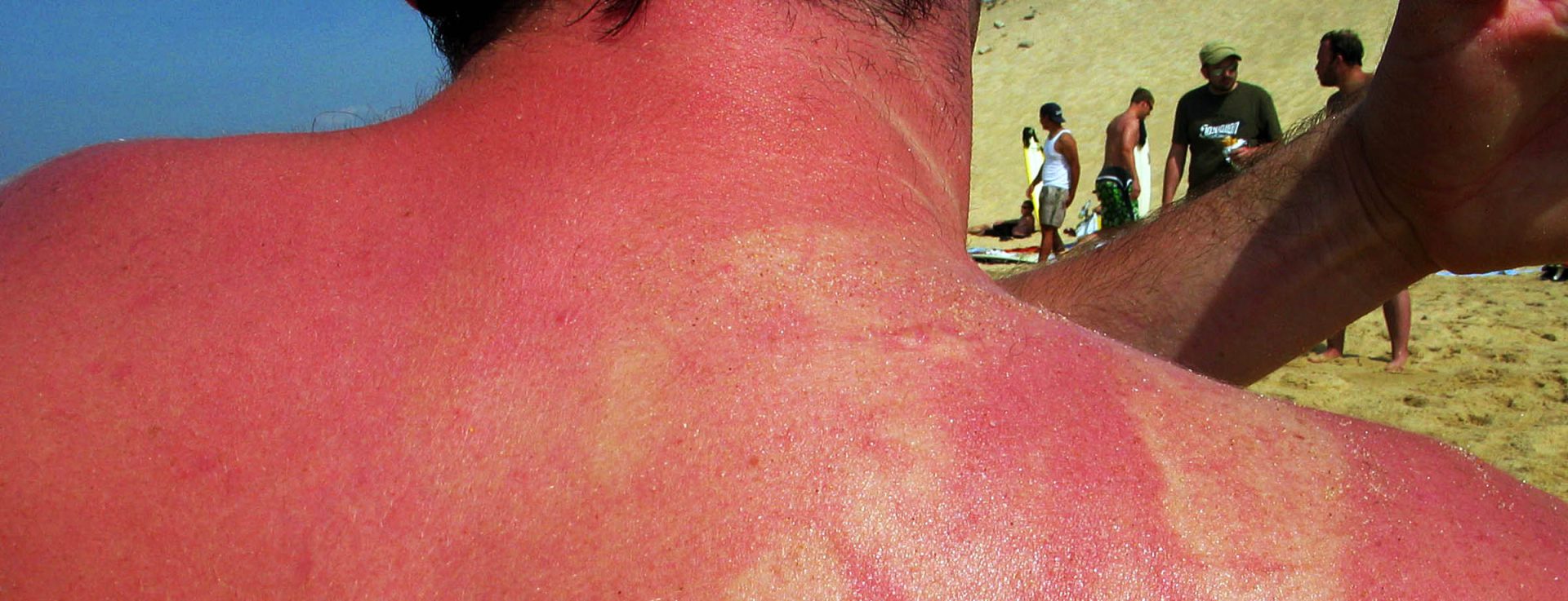 sonnenbrand