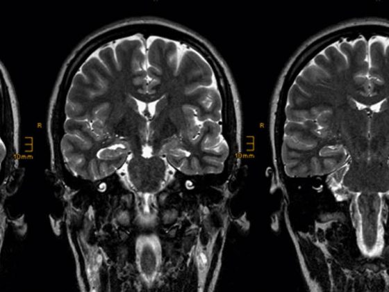 epilepsie-mri_header