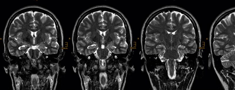 epilepsie-mri_header