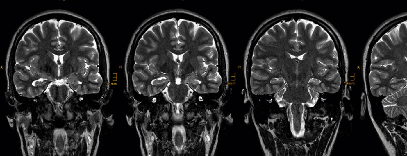 epilepsie-mri_header