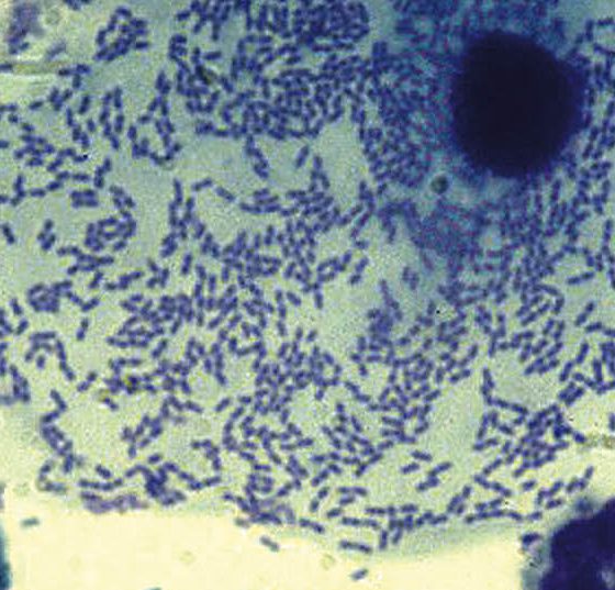 gardnerellen_gynaekologie