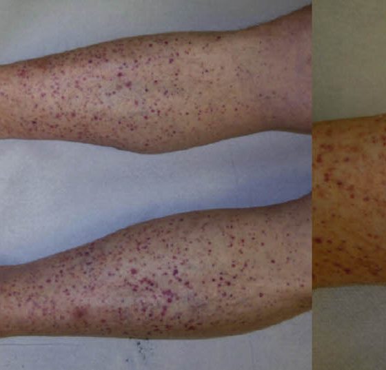 header_dp4_vaskulitis