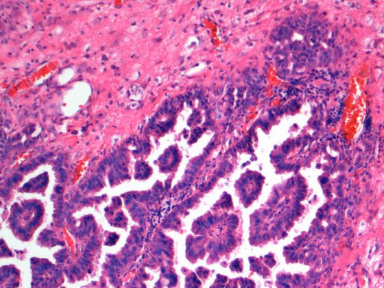 hirnmetastase