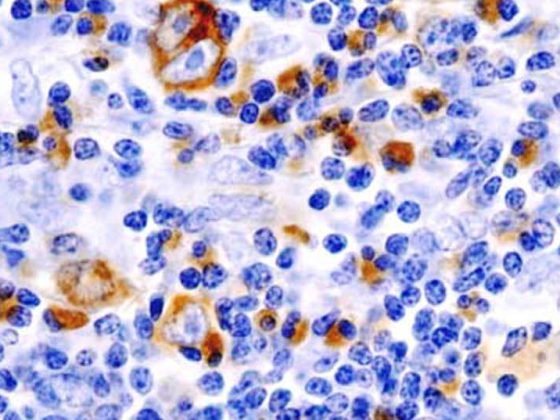 lymphom