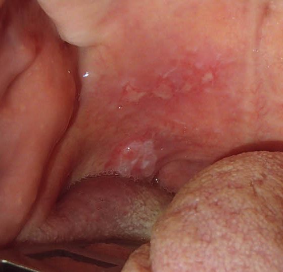 mundbodenkarzinom_oh10