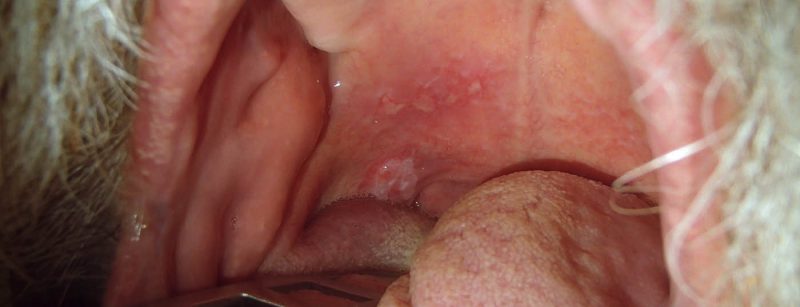 mundbodenkarzinom_oh10