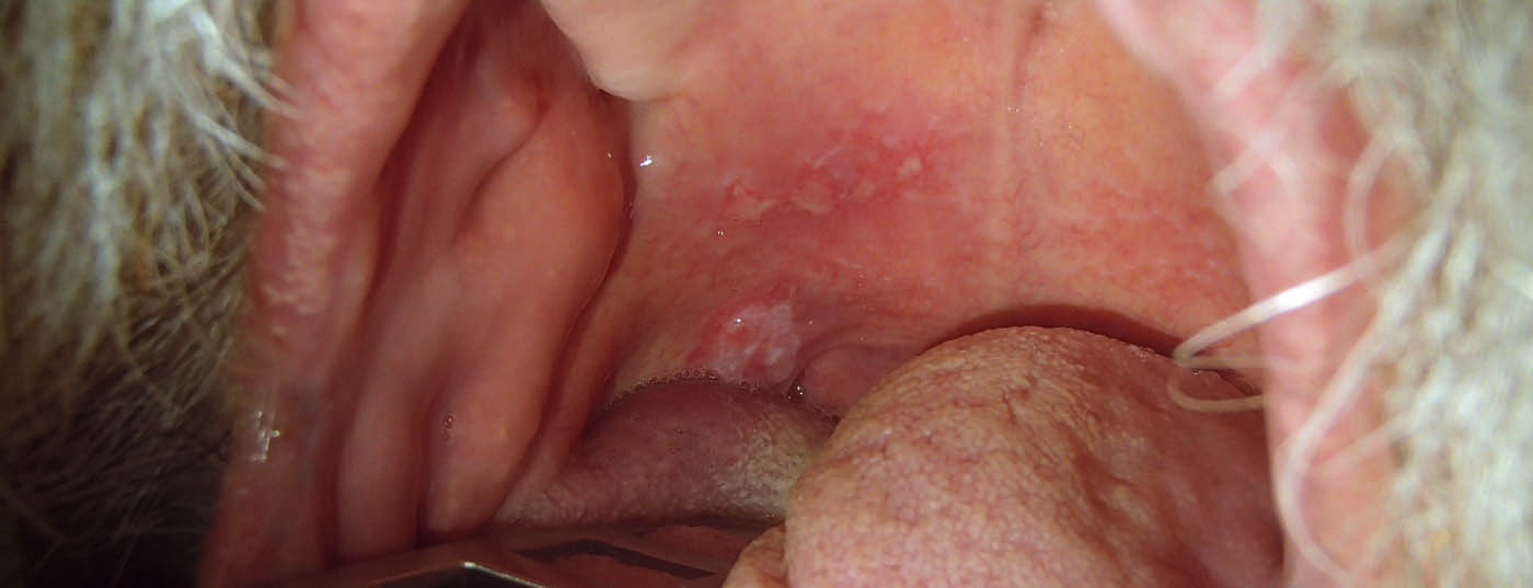 mundbodenkarzinom_oh10