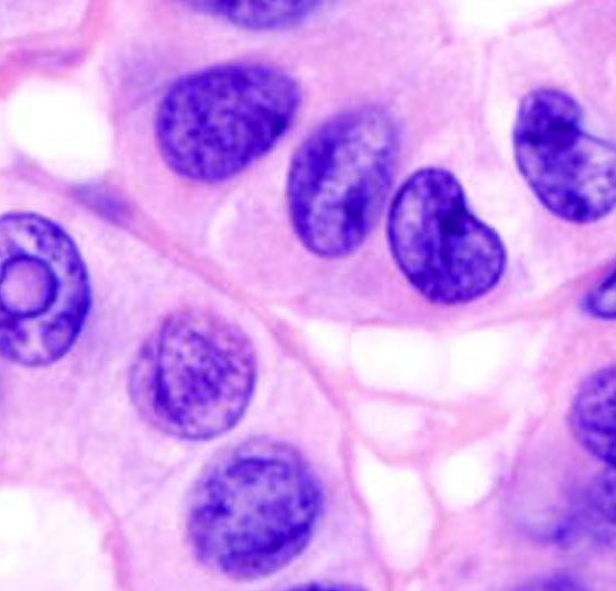 schilddruesenkrebs_papillaer