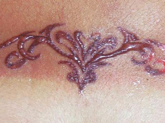 allergie_tattoo_blackhenna