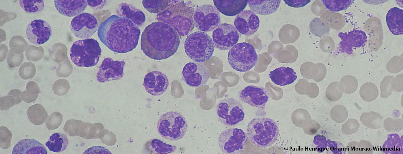 chronic_myeloid_leukemia_smear_2009-04-09