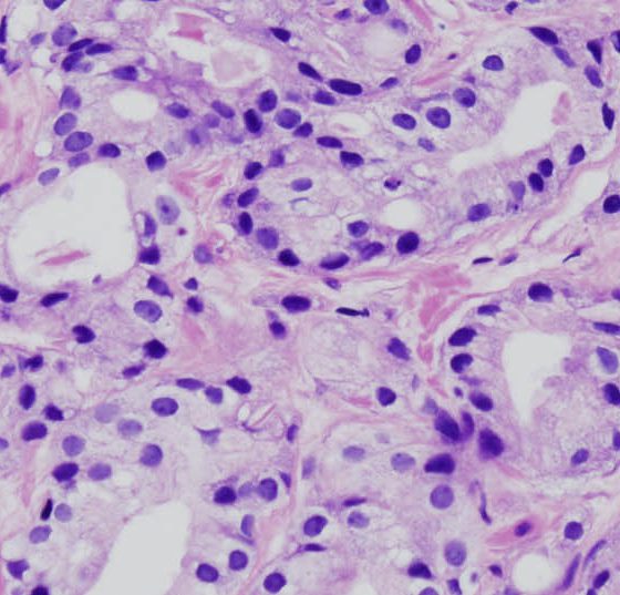 prostatakrebs_histo2