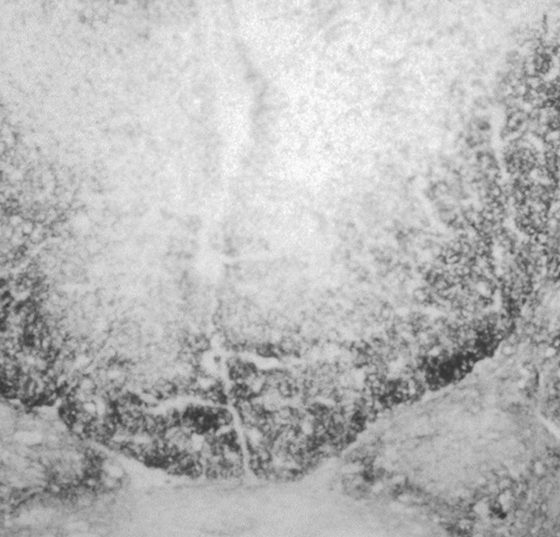 tabes_dorsalis_wikimedia