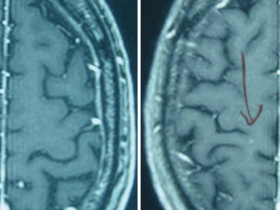 hirnmetastase_hirntumor