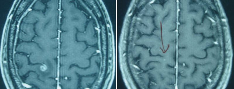 hirnmetastase_hirntumor