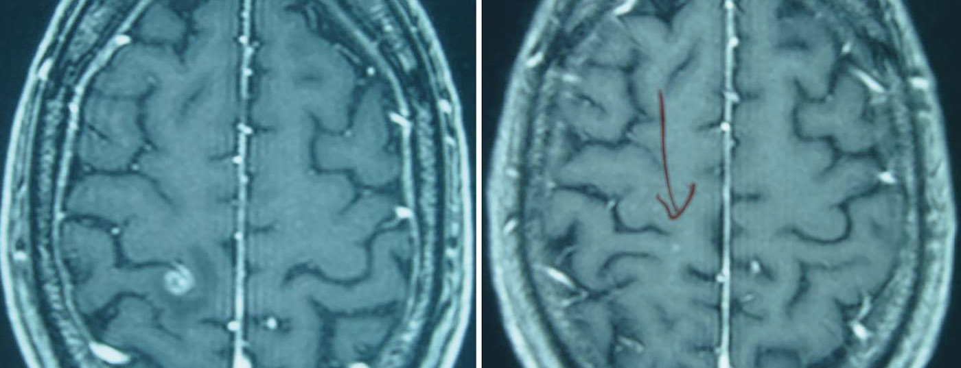 hirnmetastase_hirntumor