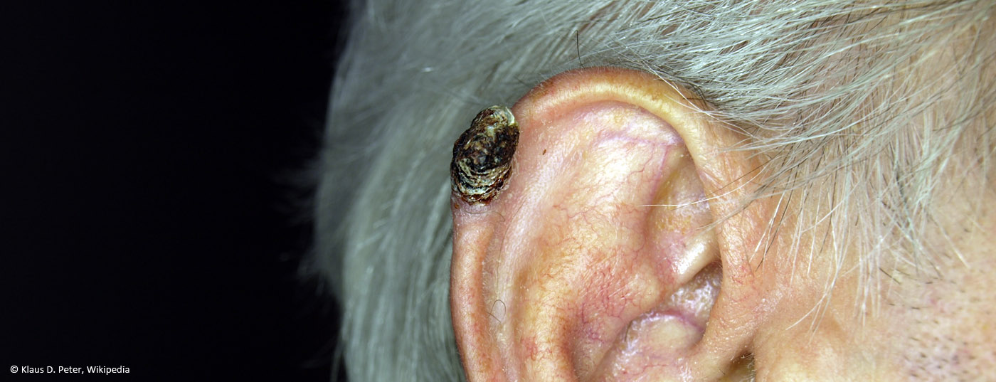 basaliom_hautkrebs
