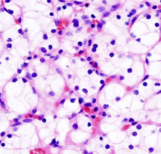 nierenkrebs_nierenkarzinom_wikimedia-free