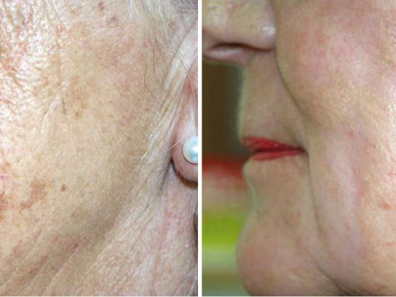 falten_peeling_kreyden