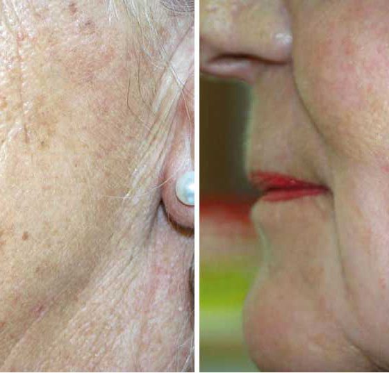 falten_peeling_kreyden