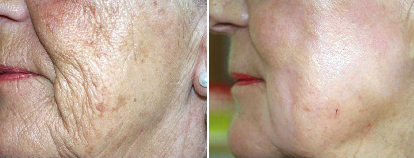 falten_peeling_kreyden