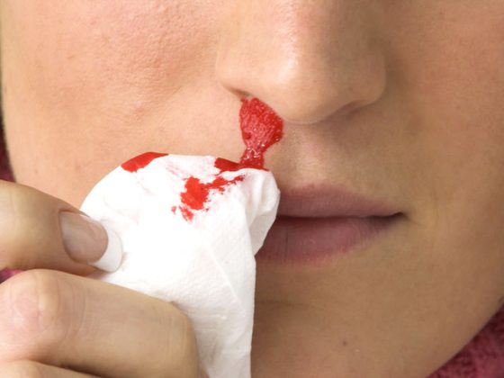 nasenbluten_head