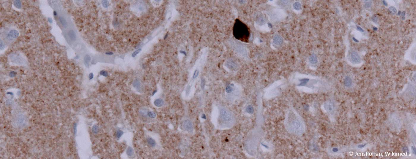 parkinson_a_synuclein_cortex_dlb