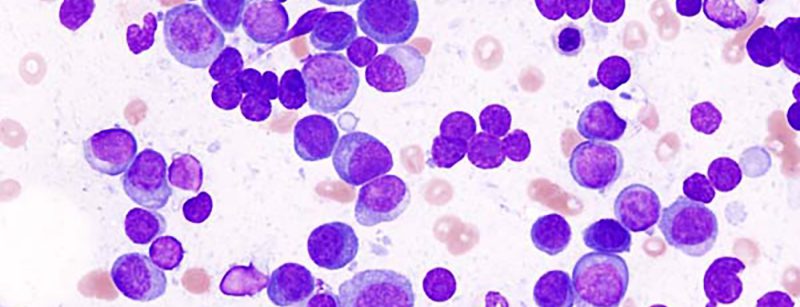 multiple_myeloma