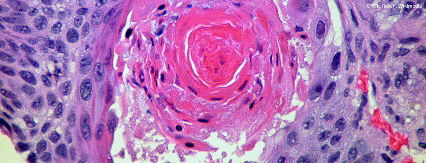 plattenepithelkarzinom_lungenkrebs