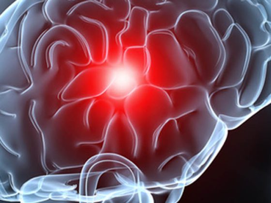 gehirn_hirnmetastase_hirnschlag