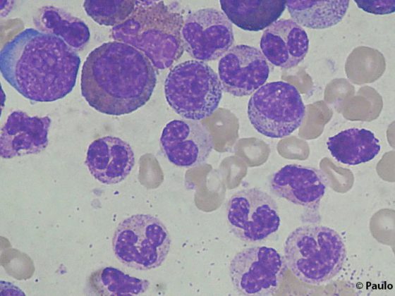 chronic_myeloid_leukemia_smear_2009-04-09