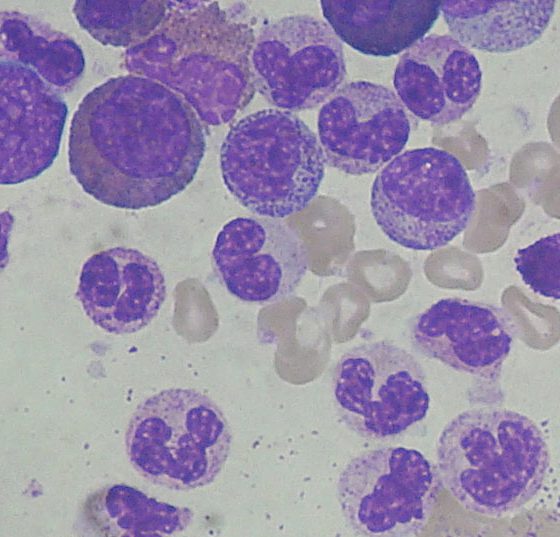 chronic_myeloid_leukemia_smear_2009-04-09