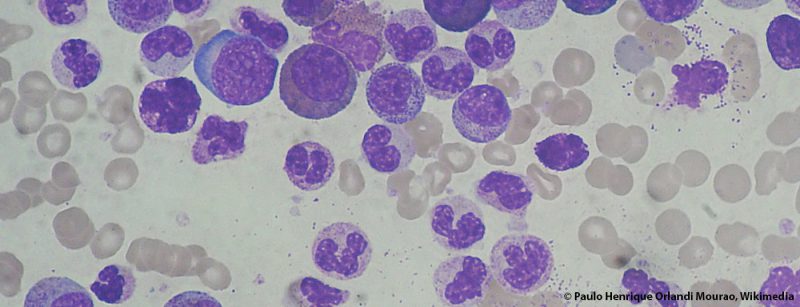 chronic_myeloid_leukemia_smear_2009-04-09