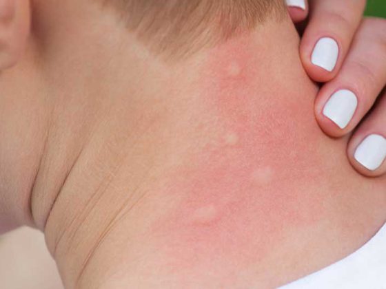 insekten_mueckenstich