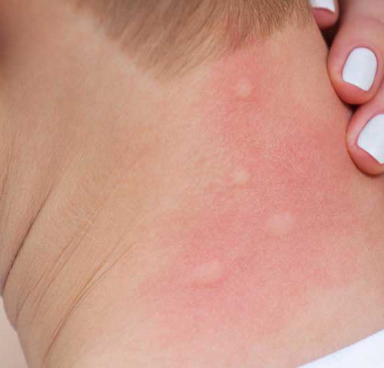 insekten_mueckenstich