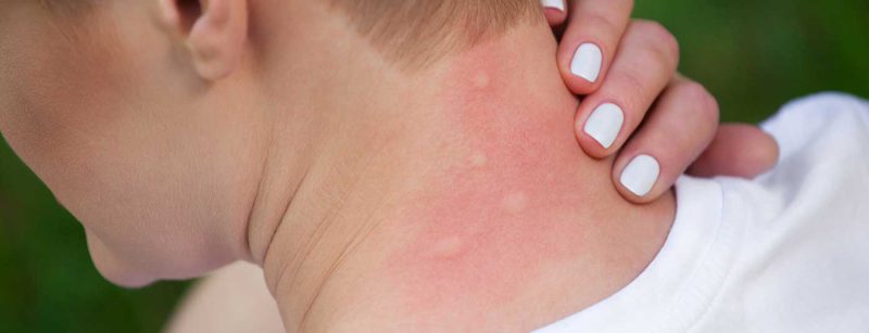 insekten_mueckenstich