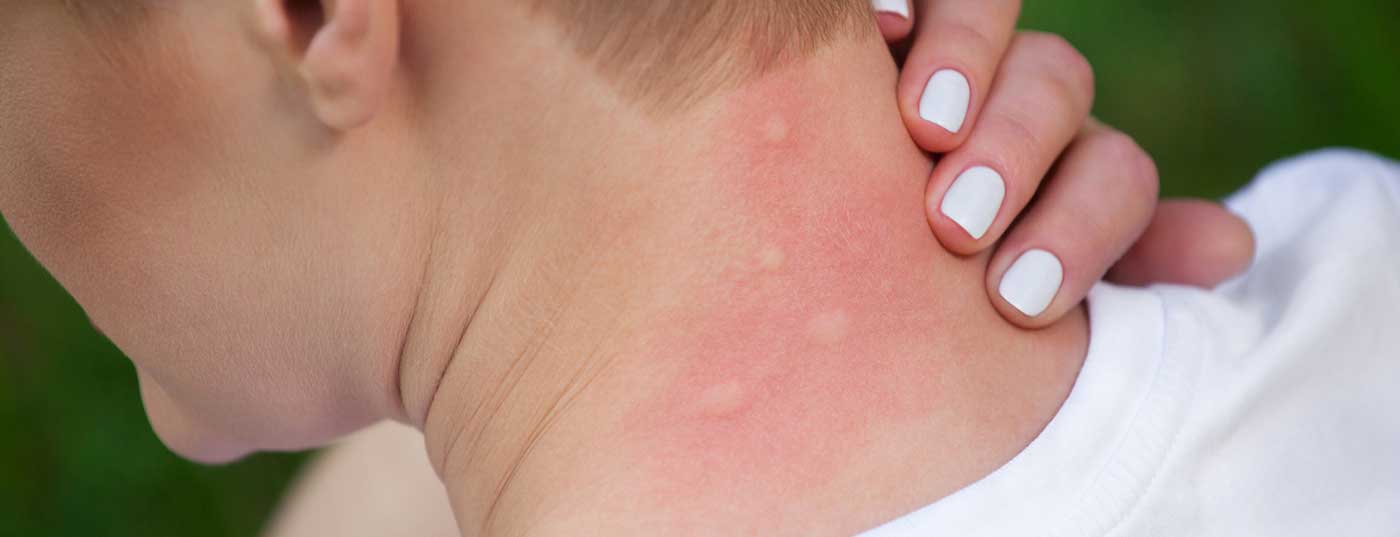 insekten_mueckenstich