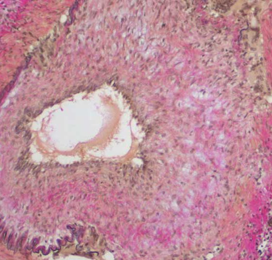 riesenzellarteriitis