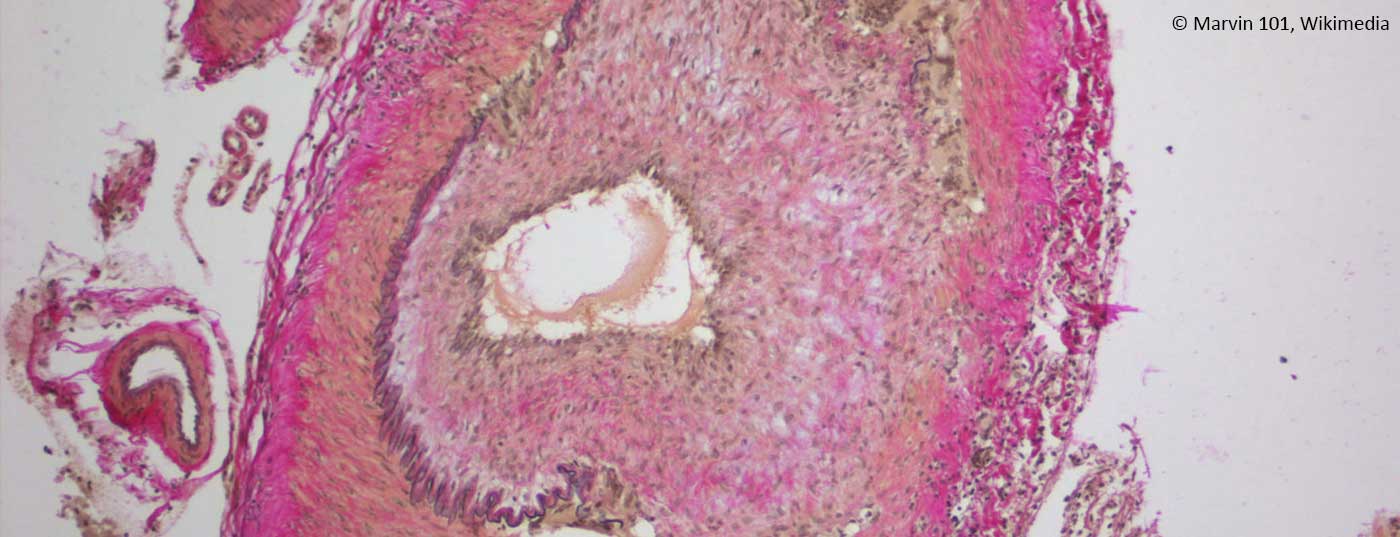 riesenzellarteriitis