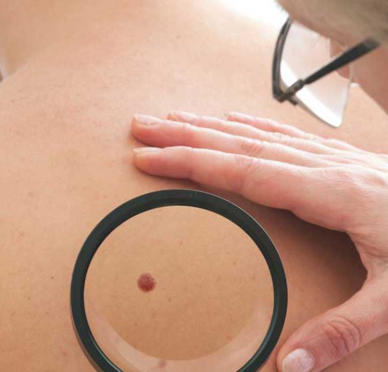 haut_hautkrebs_muttermal_untersuchung