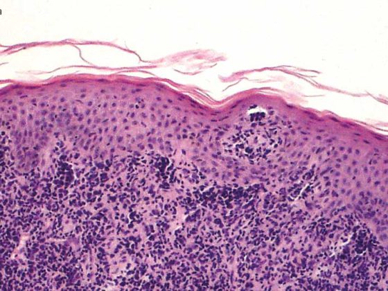 mycosis_fungoides_wikimedia