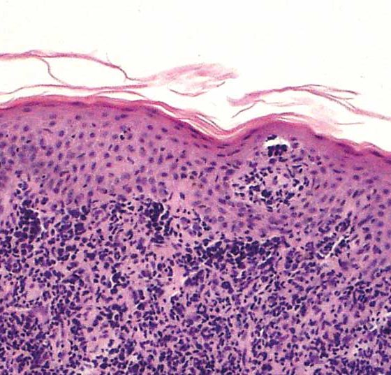 mycosis_fungoides_wikimedia