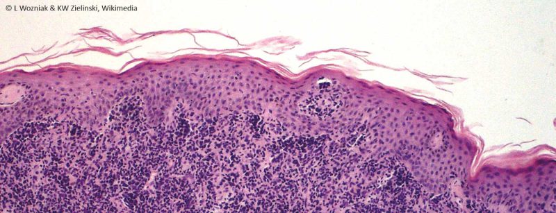 mycosis_fungoides_wikimedia