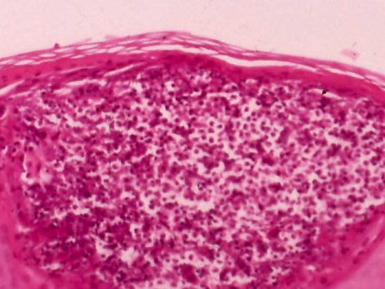 folliculitis_demodicose