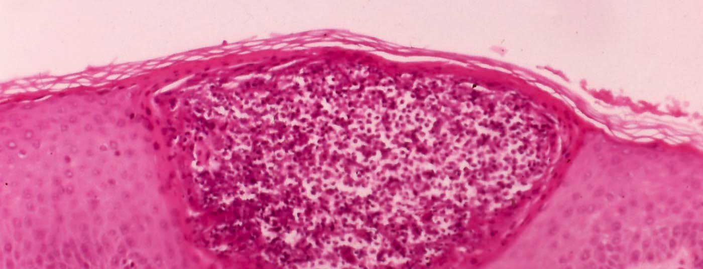 folliculitis_demodicose