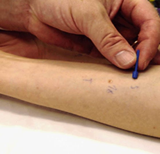prick_allergie_test