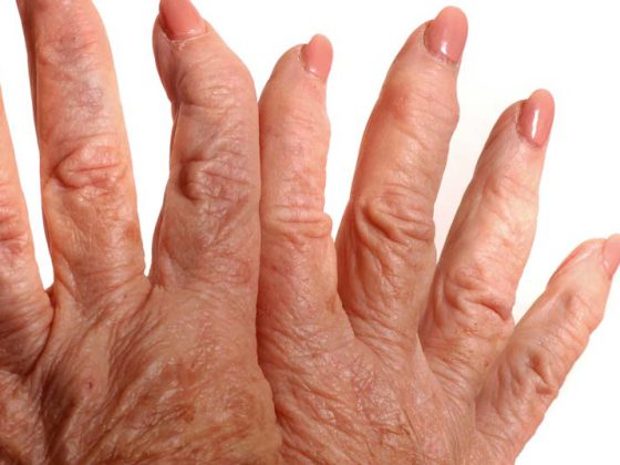 rheuma-arthritis_hand